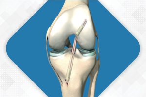 Knee Arthroscopy Implants and ACL/PCL Fixation Systems