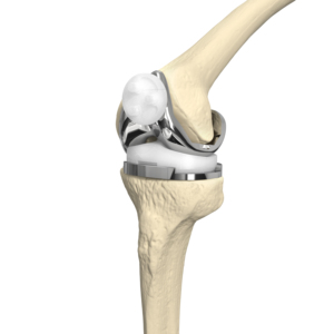 CE Certified Knee Joint Replacement Kit