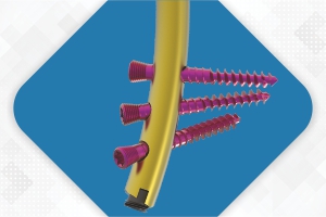 ELEGANT Distal Tibia Nail